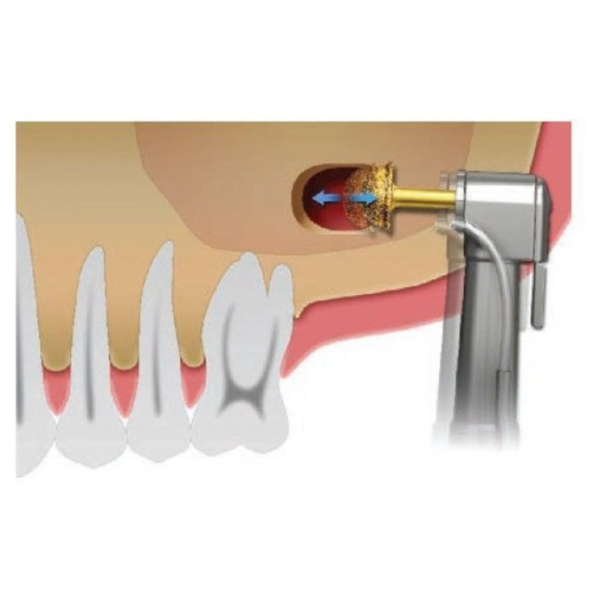Фреза для відкритого синусу DASK (Даск) № XRT064025, напівсфера 6 мм, Dentium фото 3