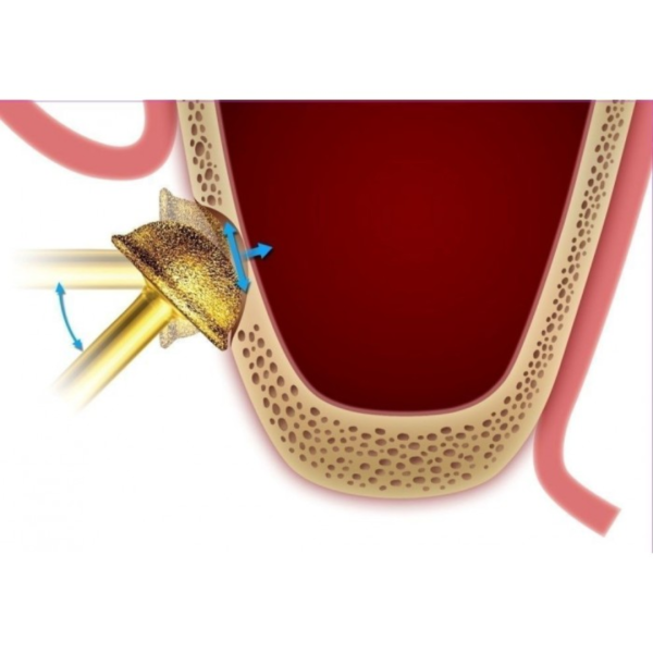 Фреза для відкритого синусу DASK (Даск) № XRT064025, напівсфера 6 мм, Dentium фото 4