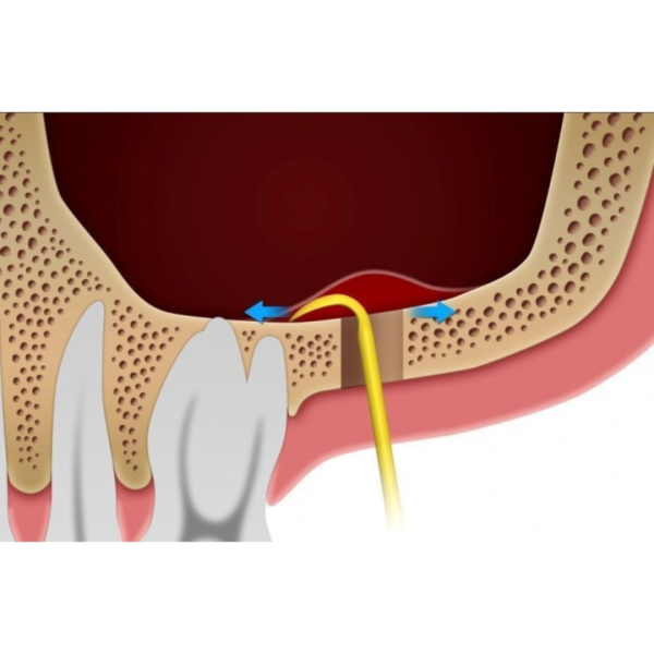 Кюрета DASK (Даск) № XSE3L середня, Dentium фото 3